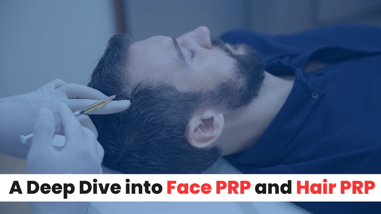 PRP (Platelet-Rich Plasma) treatment for hair restoration